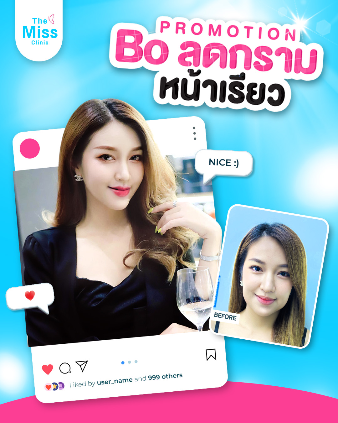 ฉีดโบท็อก ตรงไหนดี ?