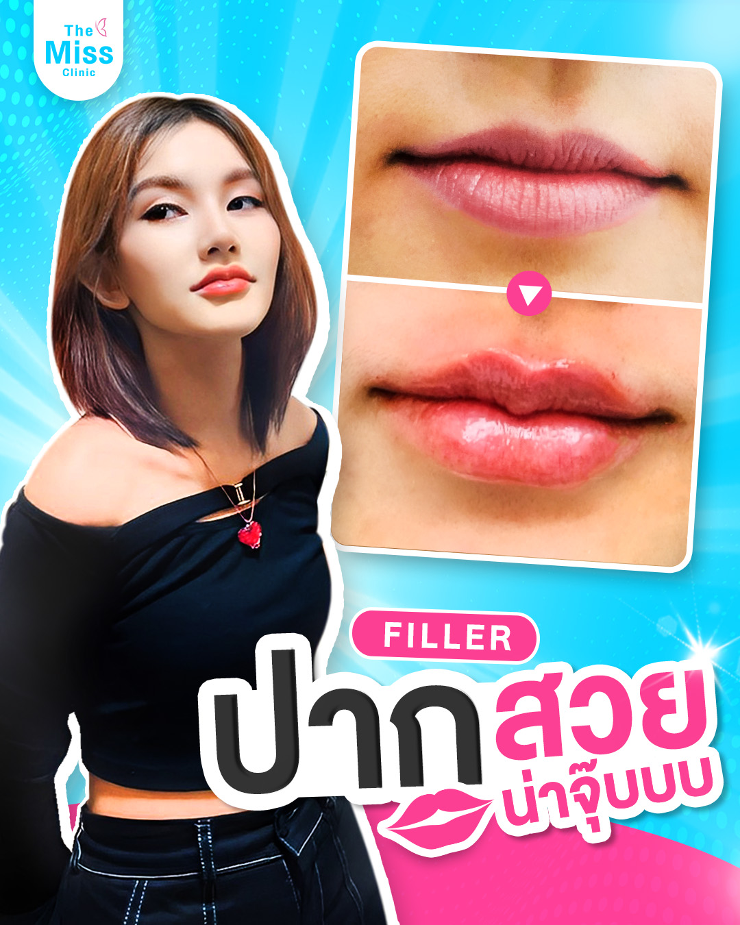 ฟิลเลอร์