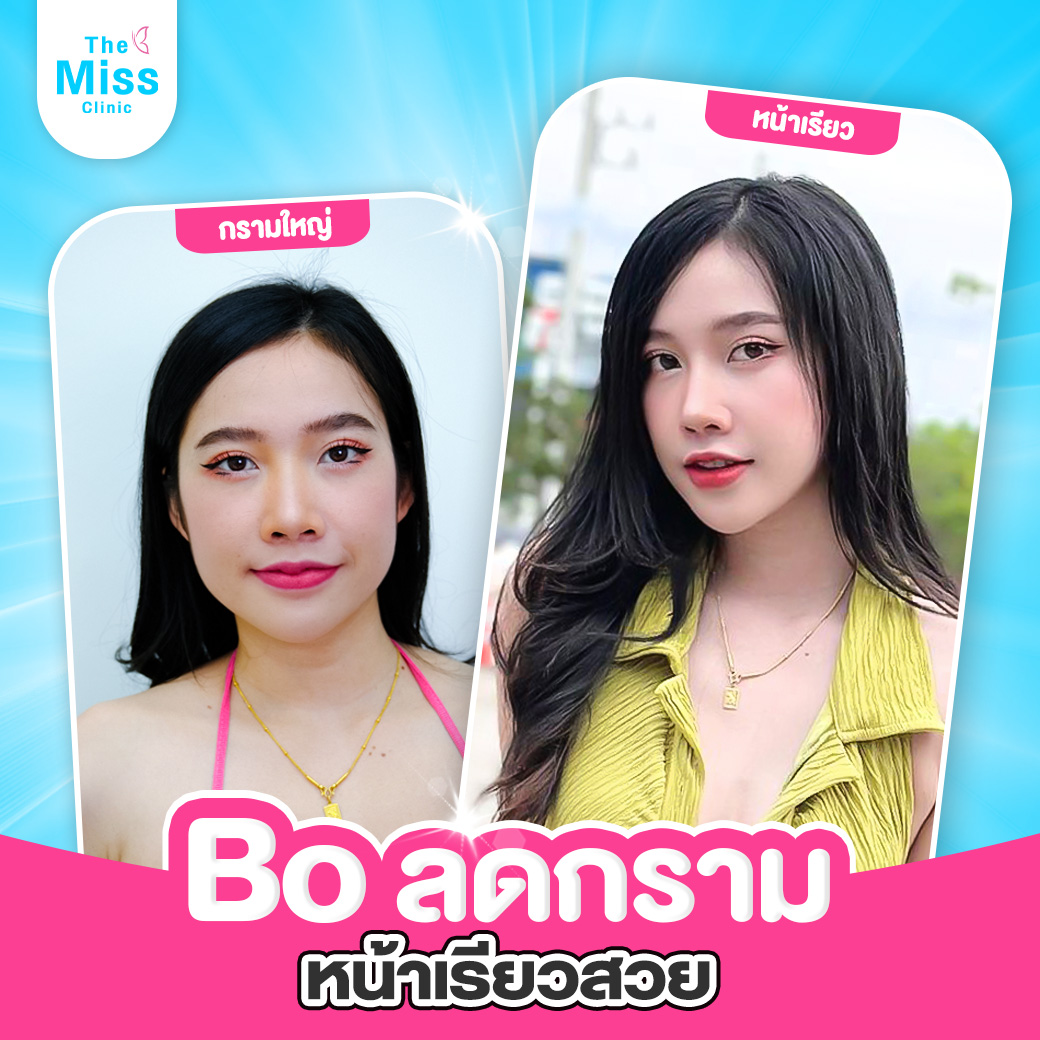 ฉีดโบท็อก ตรงไหนดี ?