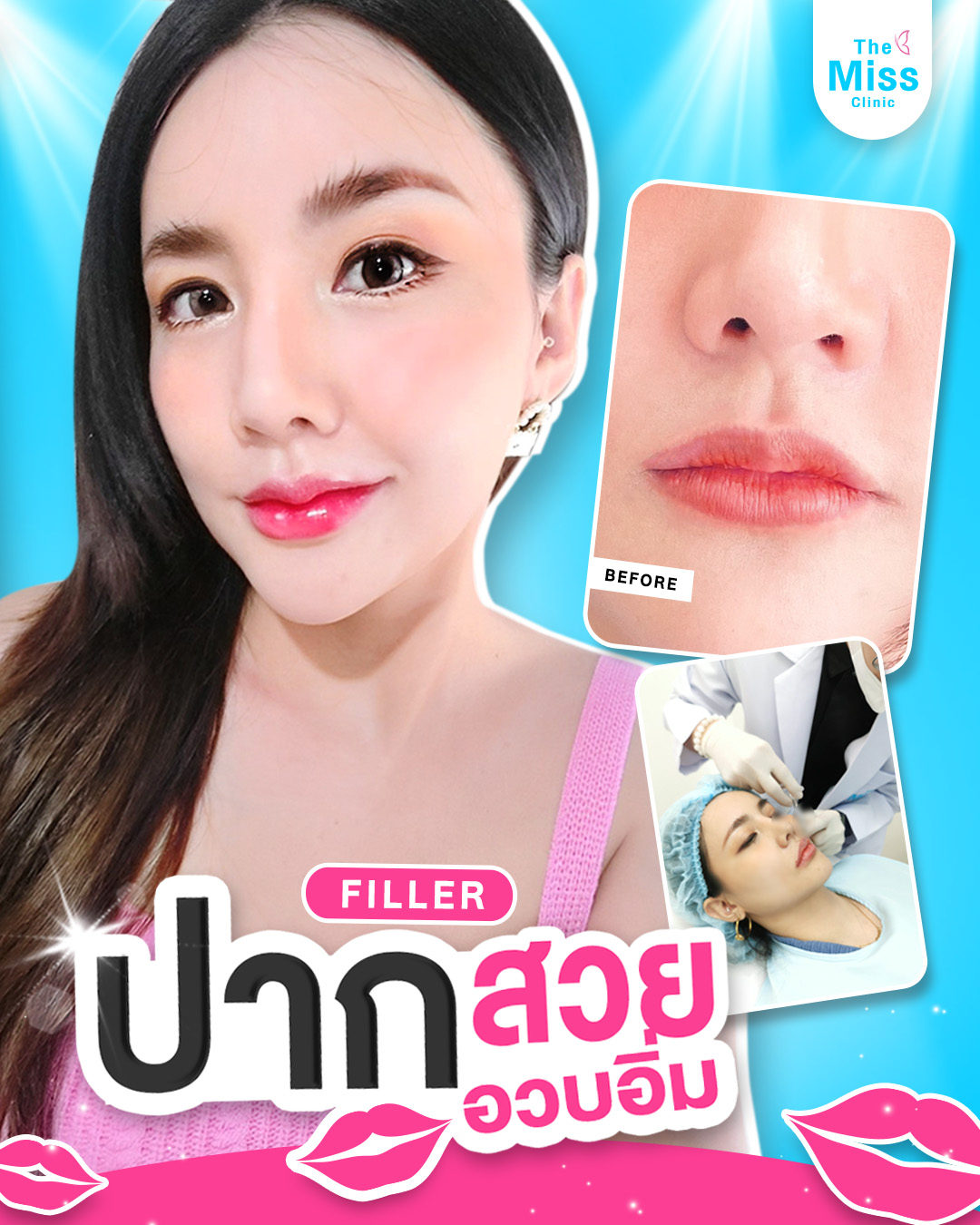 ฟิลเลอร์