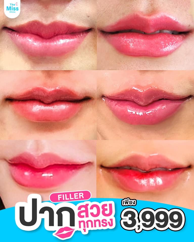 ฟิลเลอร์