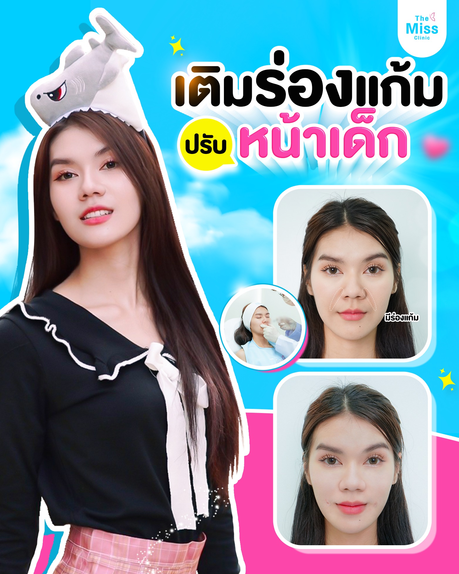 ฟิลเลอร์