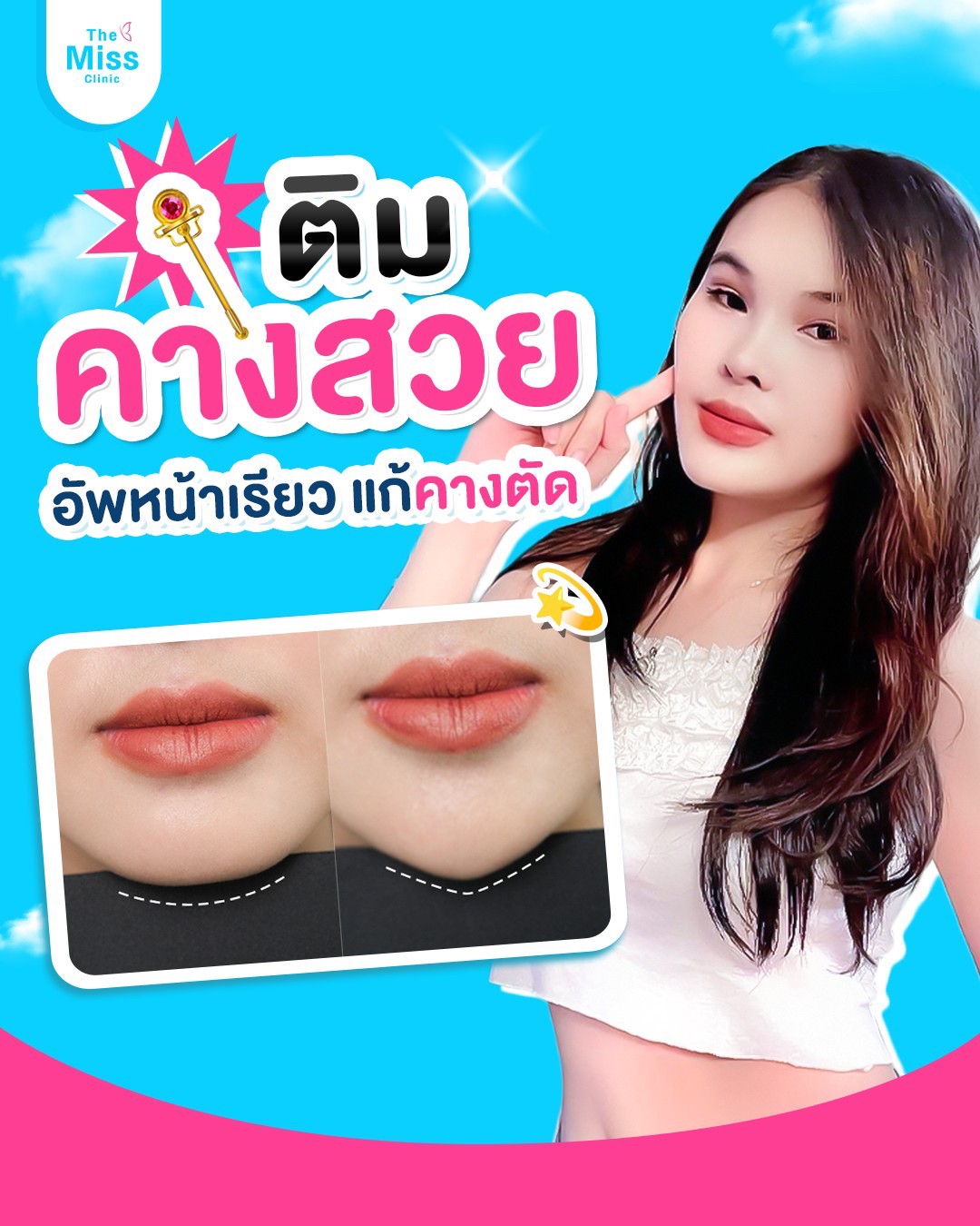 ฟิลเลอร์