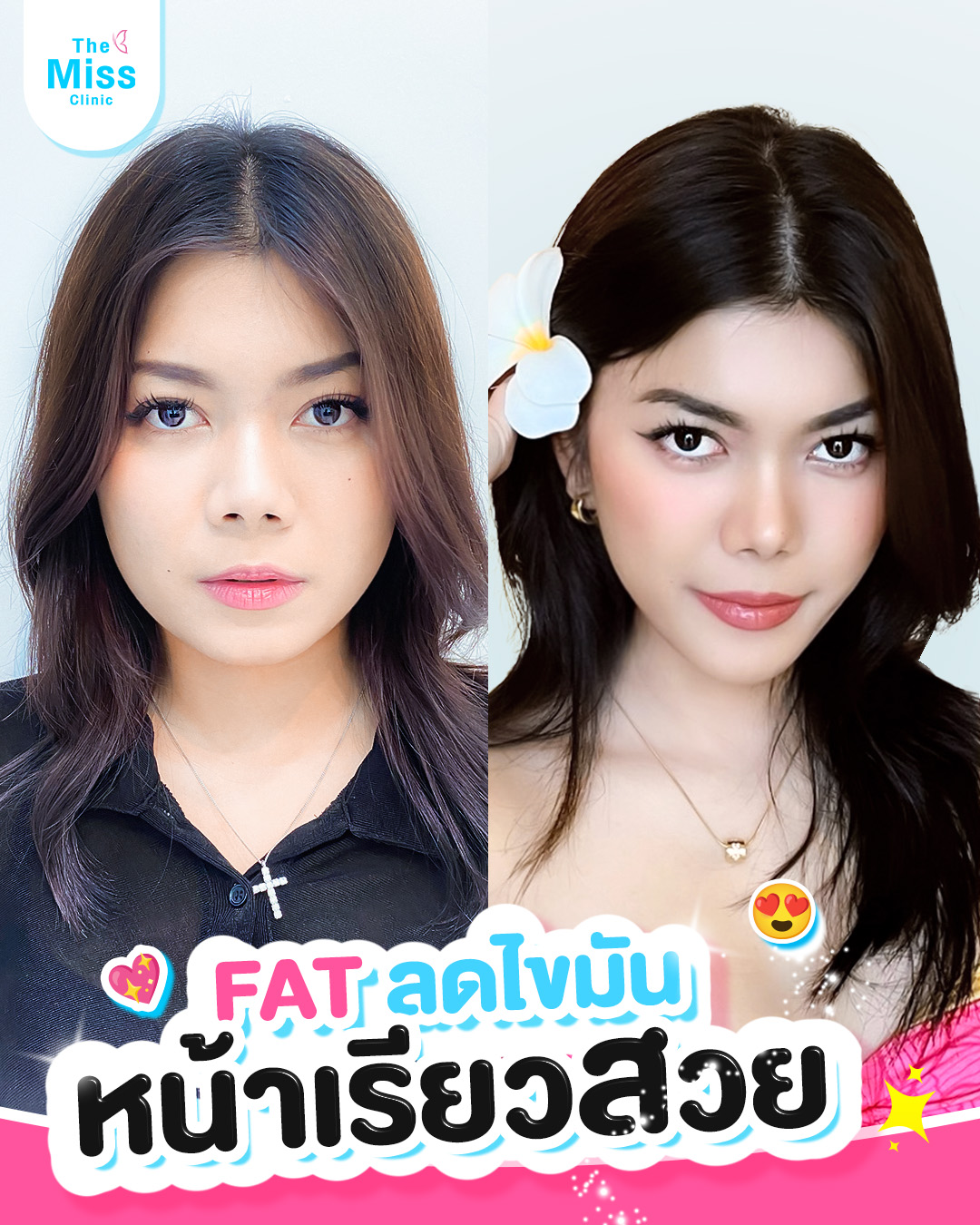 รีวิว Meso fat