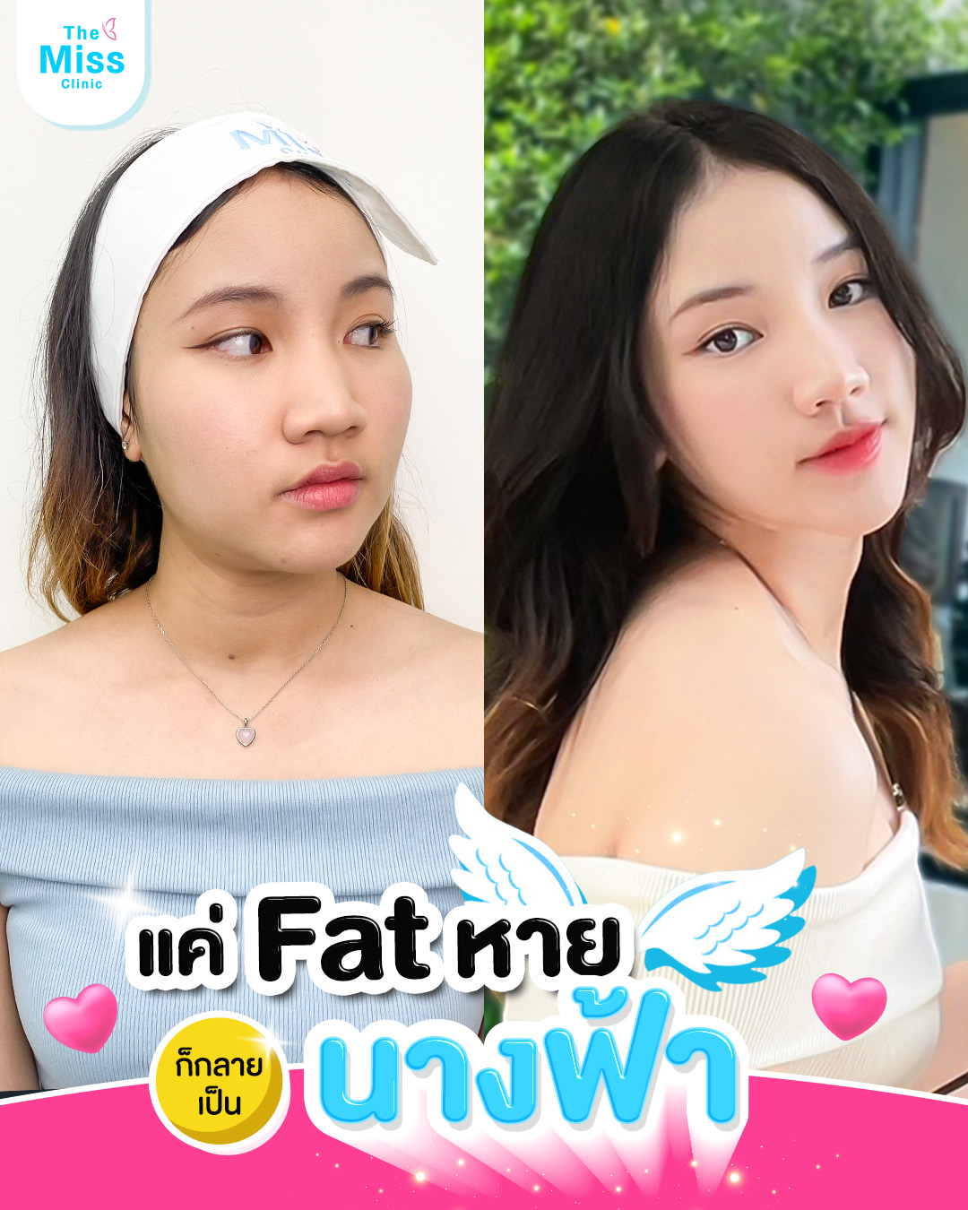 รีวิว Meso fat