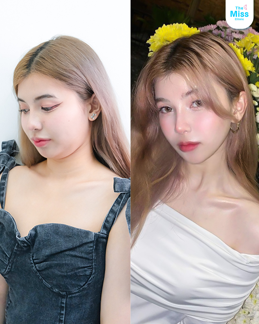 รีวิว Meso fat