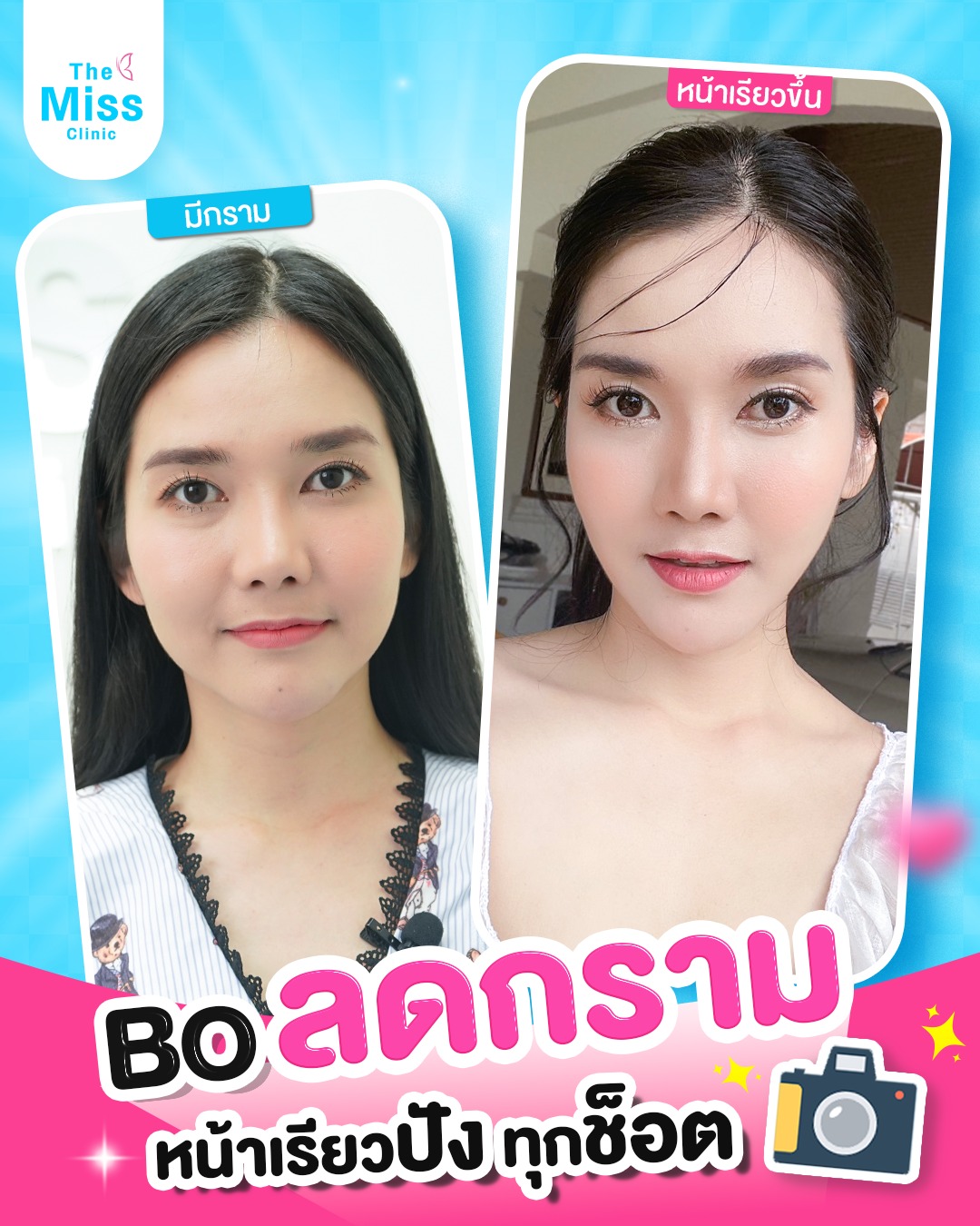 โบท็อกซ์ คืออะไร