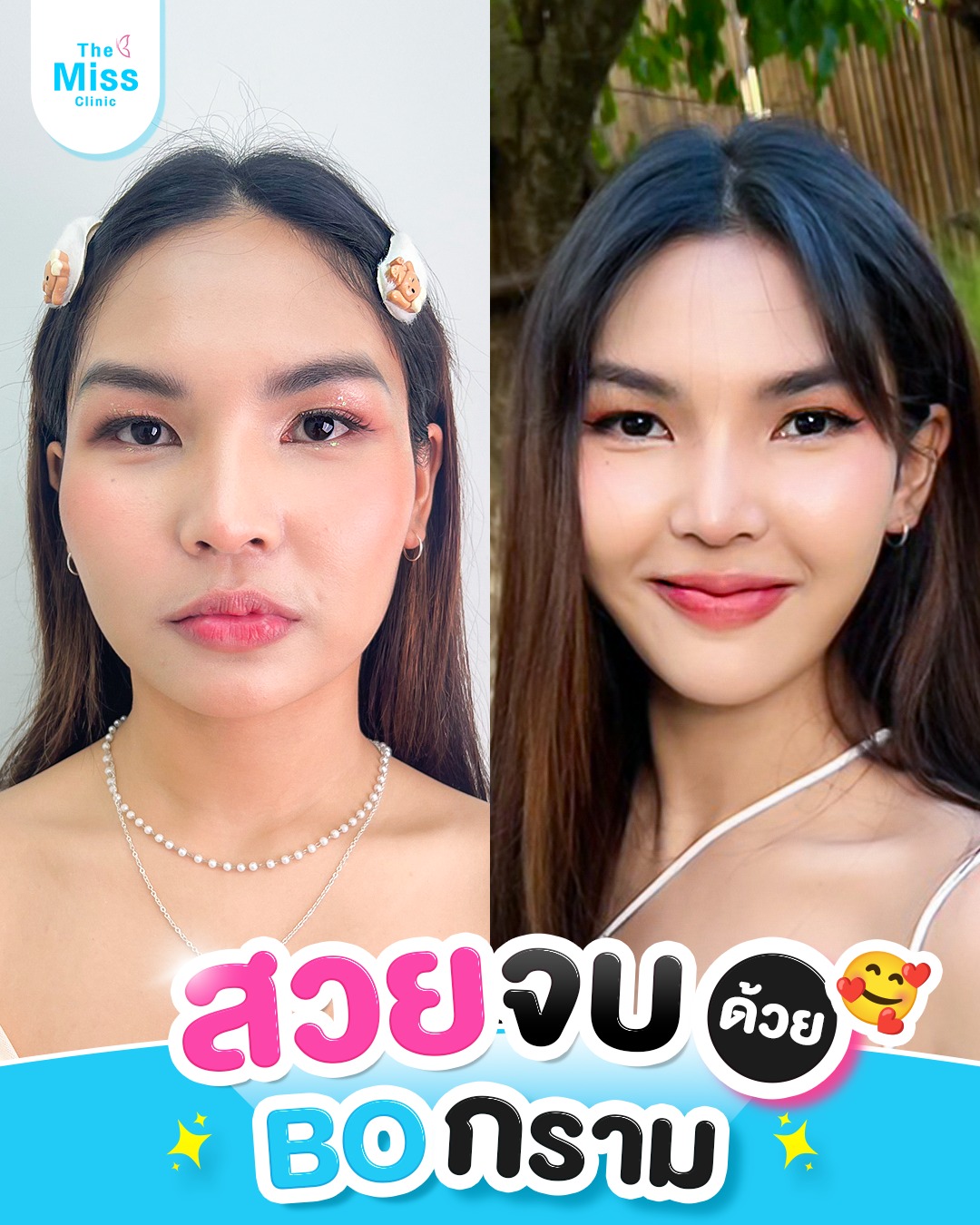 โบท็อกซ์ คืออะไร