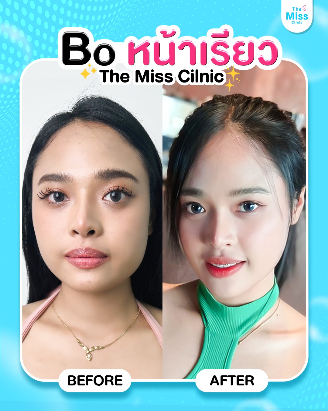 โบท็อกซ์ คืออะไร