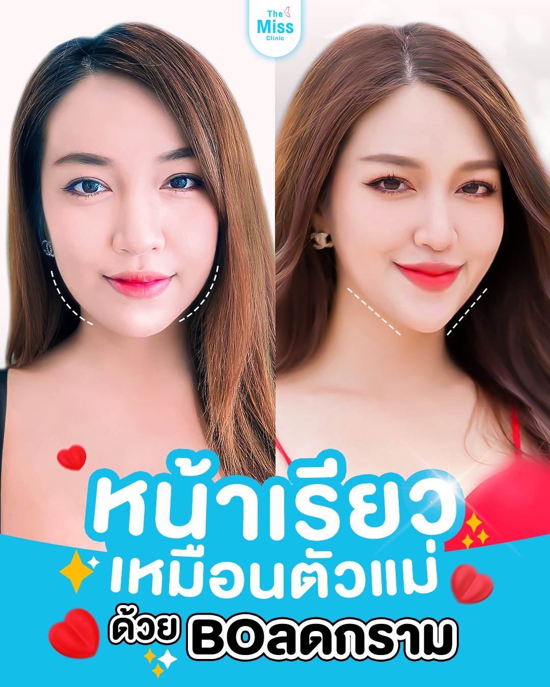 โบท็อกซ์ คืออะไร