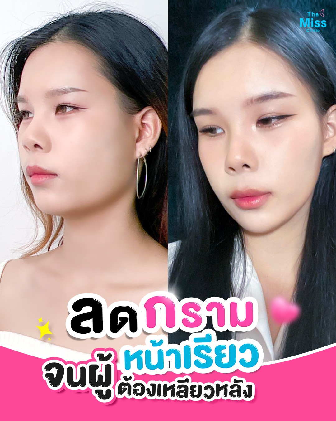 โบท็อกซ์ คืออะไร