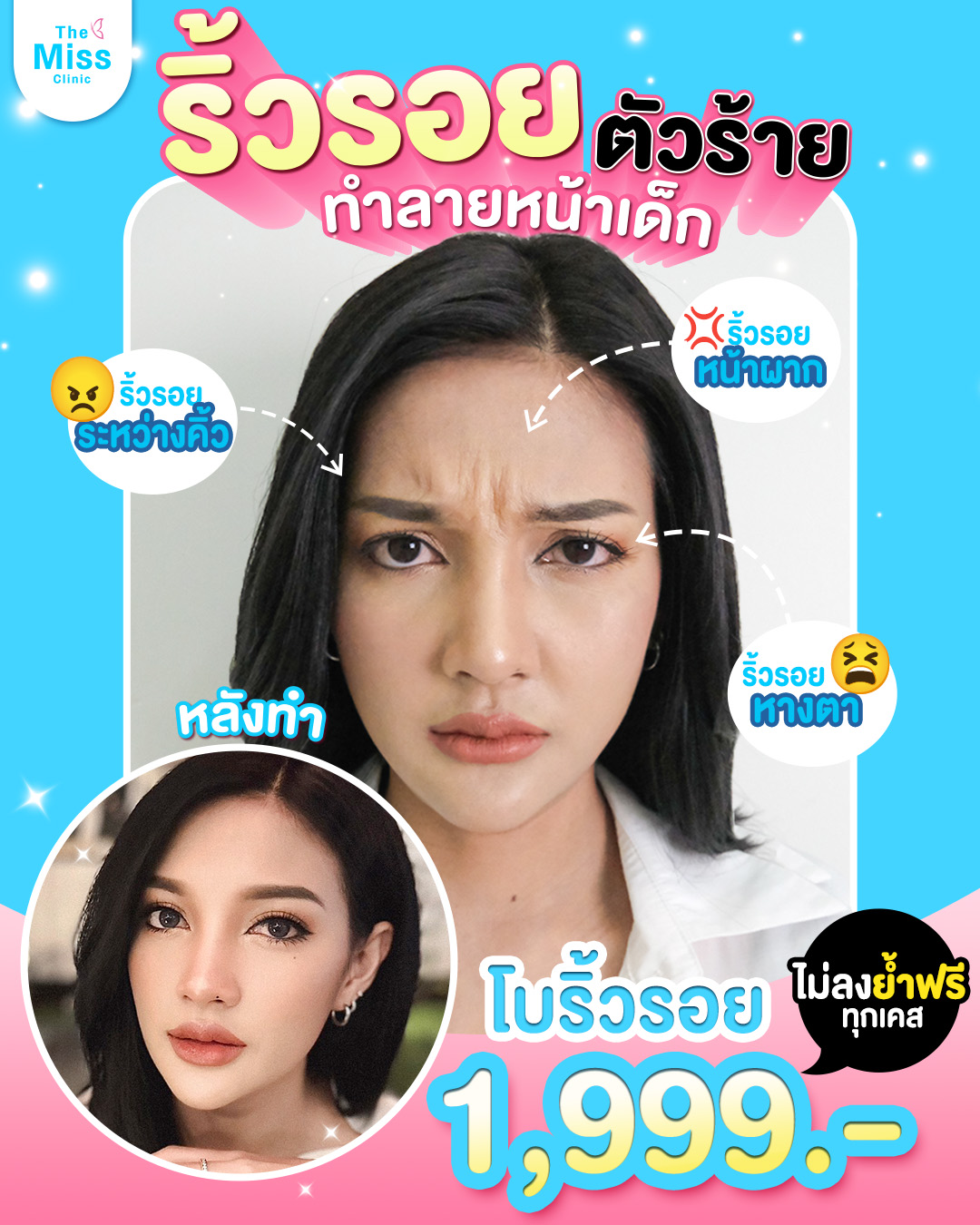 โบท็อกซ์ คืออะไร