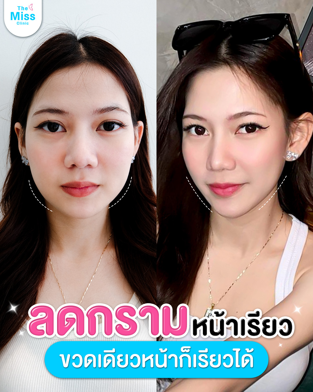 โบท็อกซ์ คืออะไร