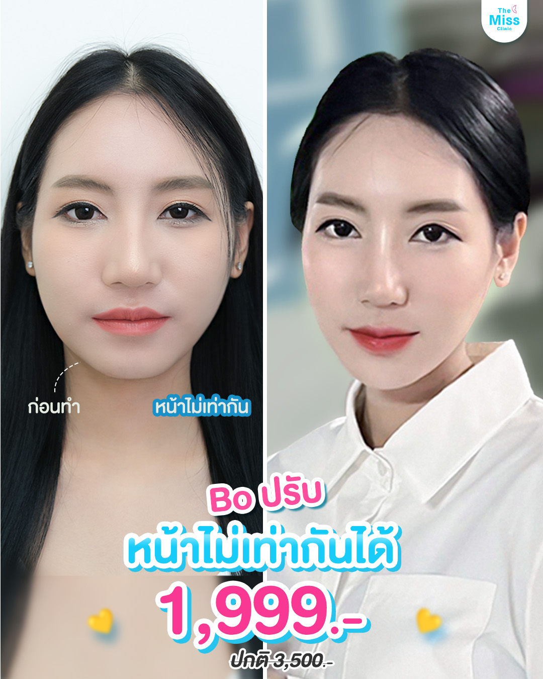 โบท็อกซ์ คืออะไร