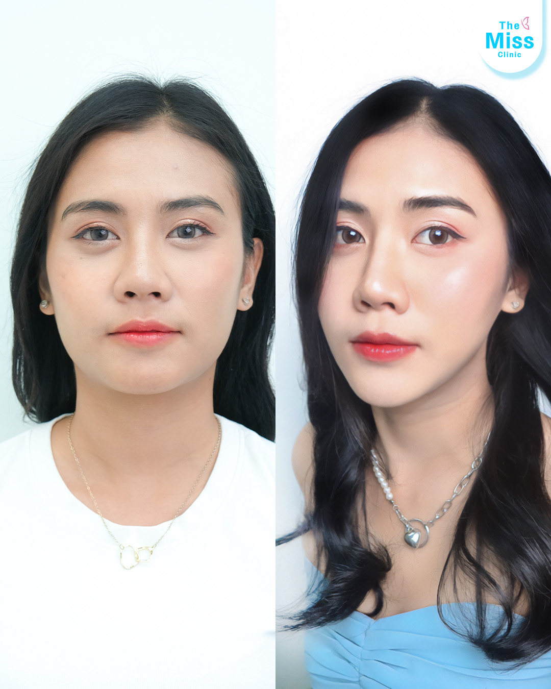 โบท็อกซ์ คืออะไร