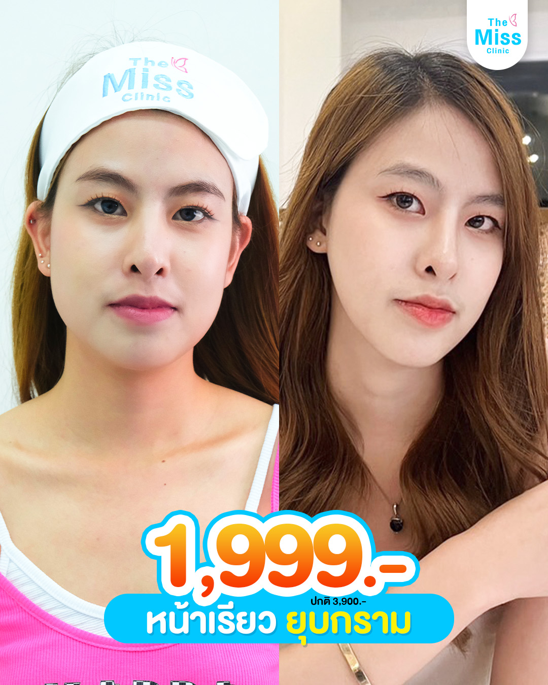 โบท็อกซ์ คืออะไร