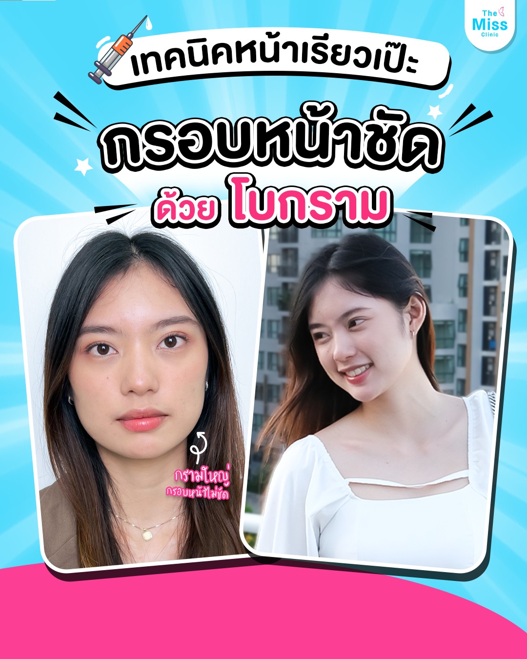 โบท็อกซ์ คืออะไร