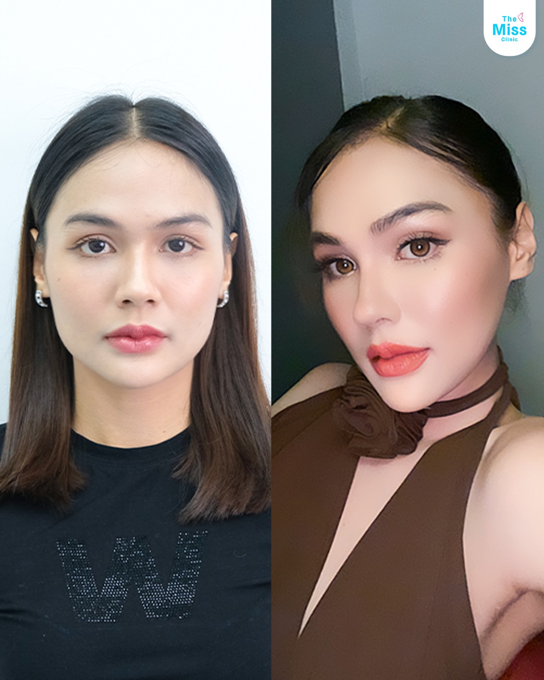 โบท็อกซ์ คืออะไร